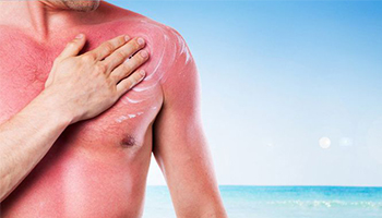 Jak ošetřit spálenou pokožku od slunce?